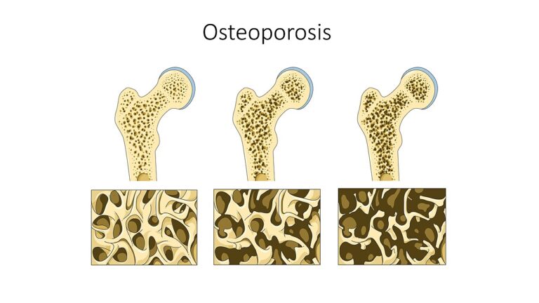 Illustration of bone structure thinning with osteoporosis, used to explain osteoarthritis vs osteoporosis at Regenerative Joint Clinics in Riverdale, GA
