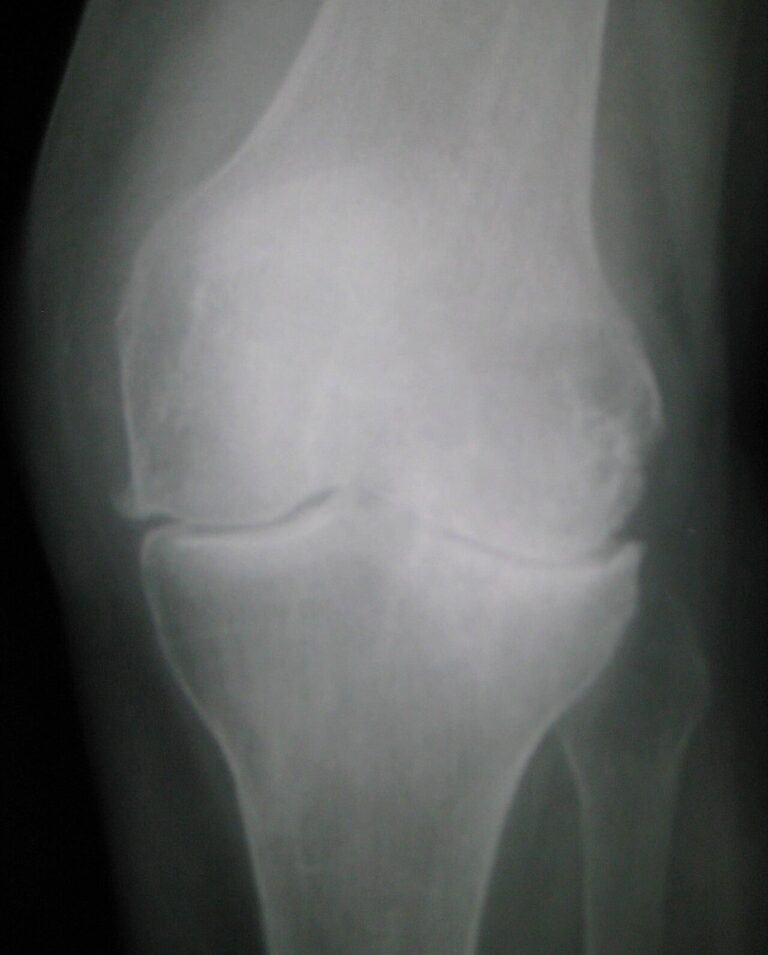 X-ray showing joint space narrowing and osteophytes, the findings used to grade the stages of knee osteoarthritis at Regenerative Joint Clinics in Riverdale, GA