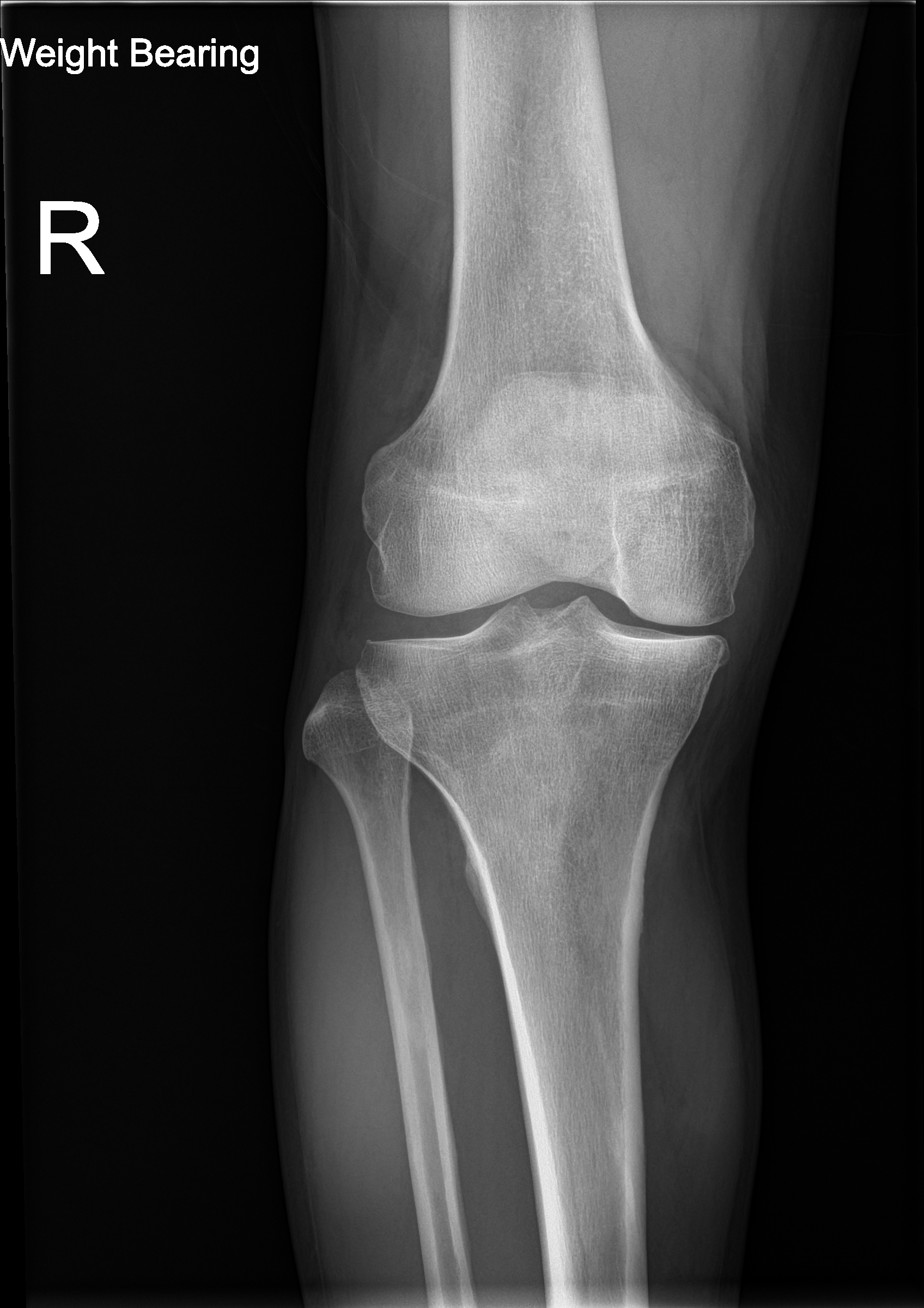 Weight-bearing knee X-ray of the type used to document osteoarthritis before joint pain treatment in Stockbridge, GA